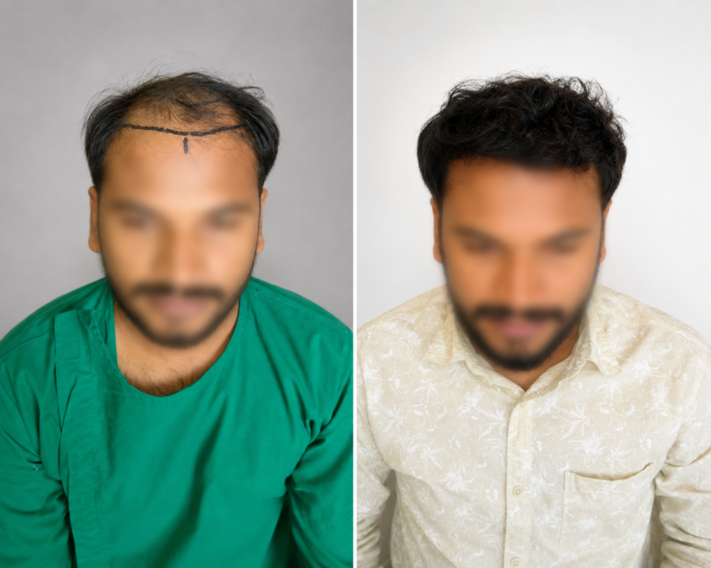 Implanter Pen Method: 3,800 grafts