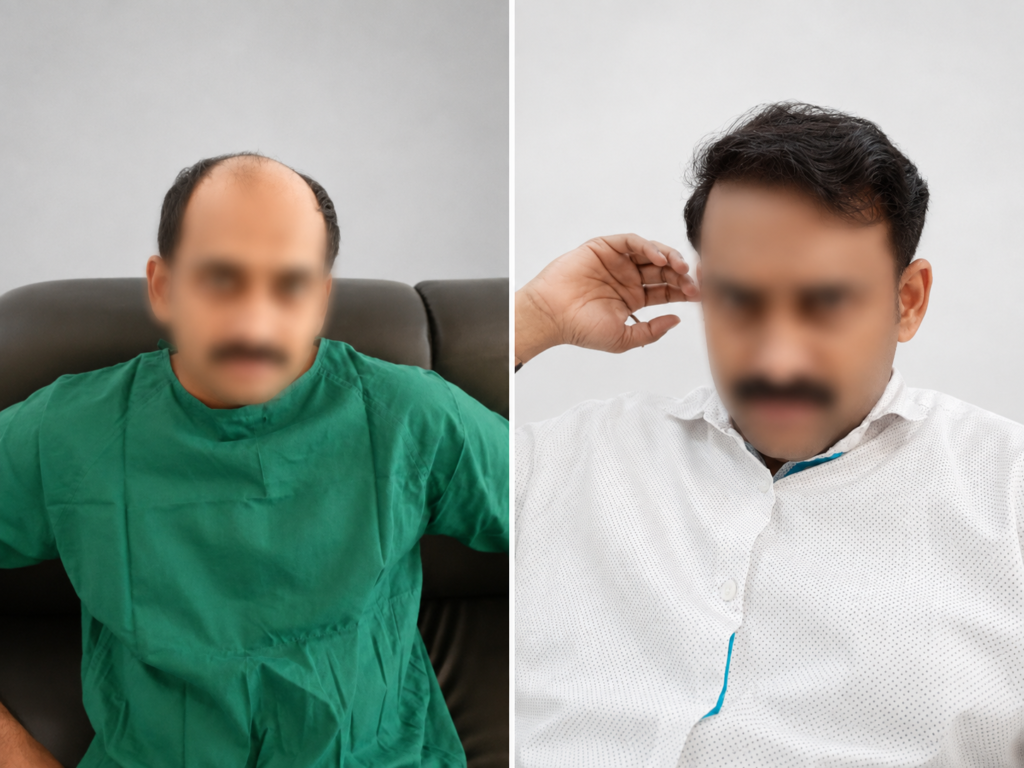 Procedure: Hair Transplantation Implanter Pen Method: 3,000 grafts at Dr Hair