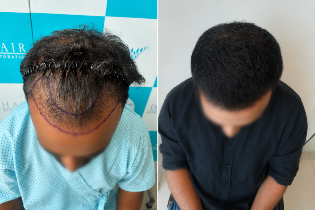 Implanter Pen Method: 2,800 grafts at Dr hair